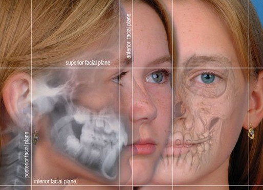 Diagram of a girl's face at different angles showing parts of the facial bone structure