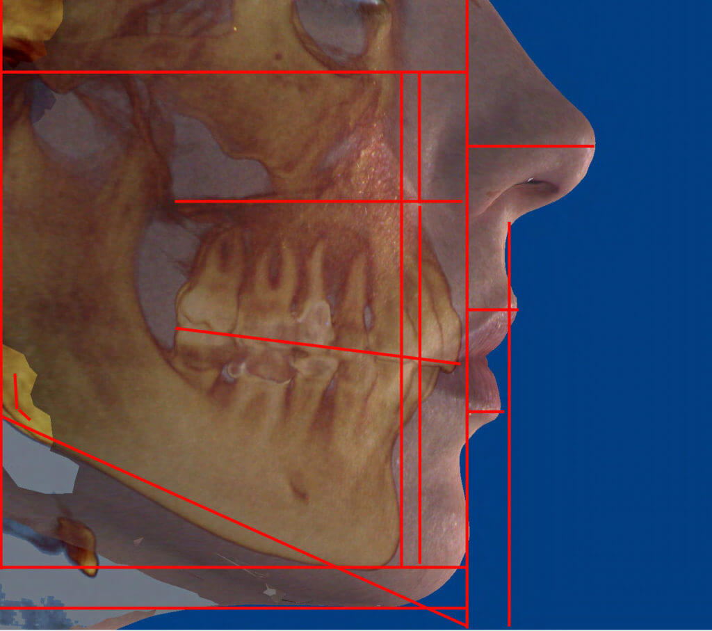 Cheek / Chin Augmentation rendering