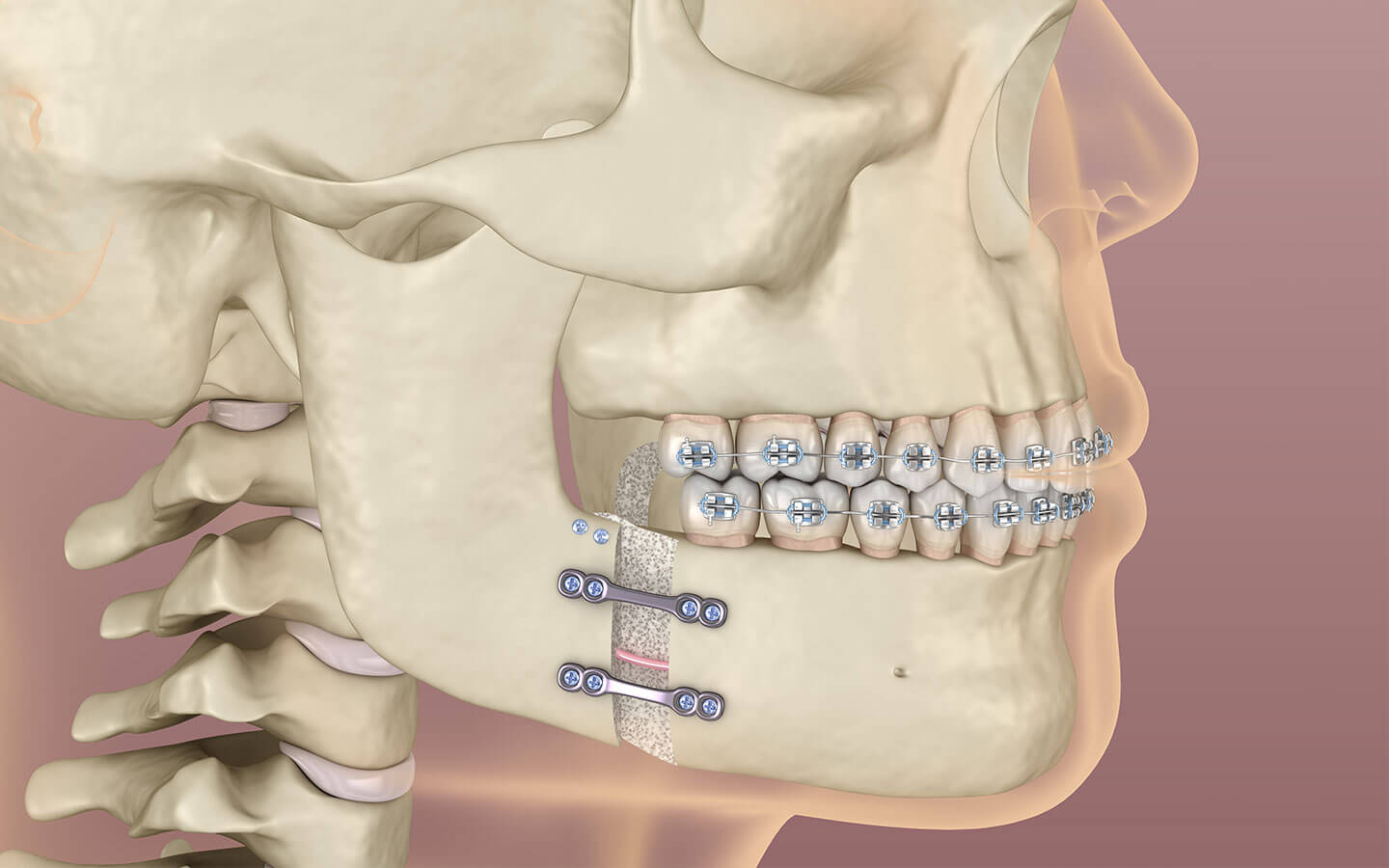 Corrective Jaw Surgery (Orthognathic)