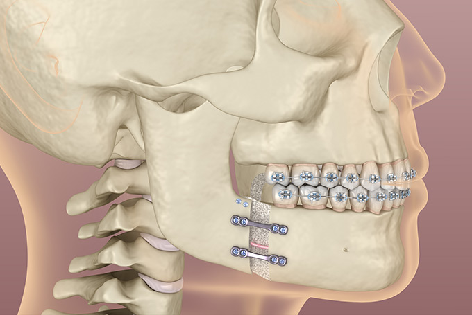 Learn about Jaw Surgery