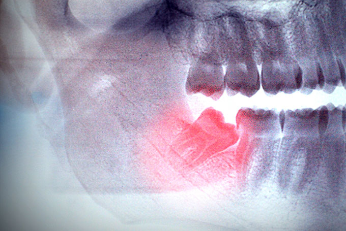 Learn about Wisdom Tooth Removal