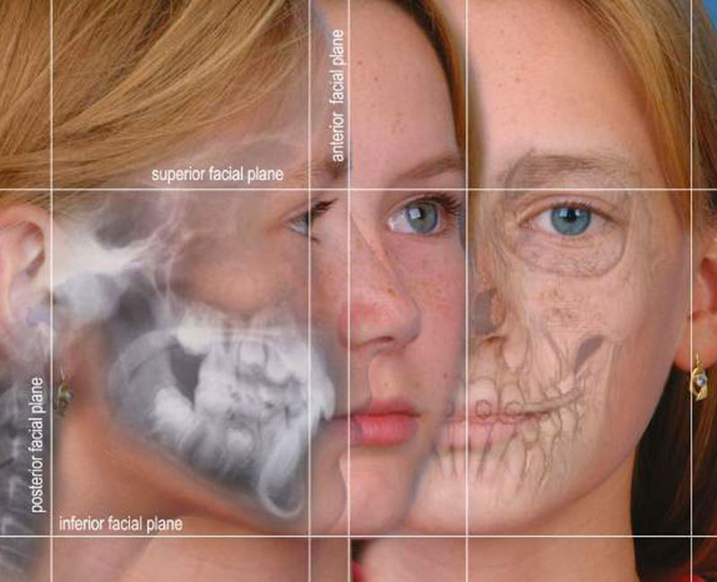 Jaw Surgery Diagram