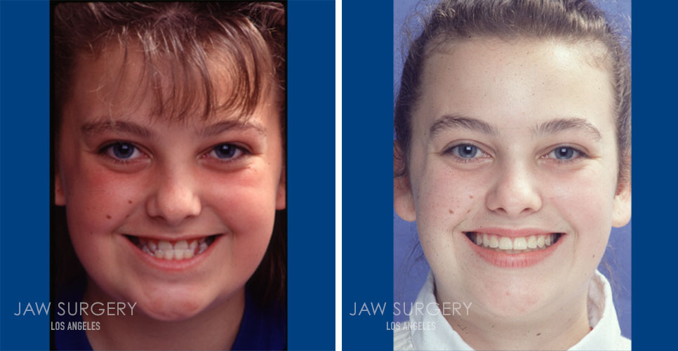 My Lips Are Smaller After Jaw Surgery | Lipstutorial.org