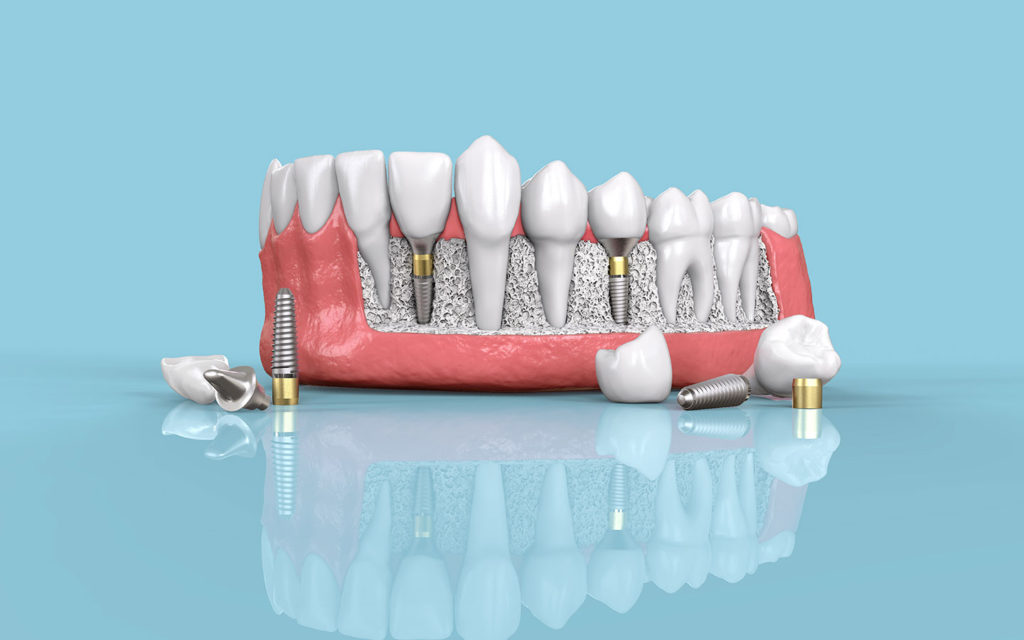 Dental Implants in Los Angeles, CA Jaw Surgery LA