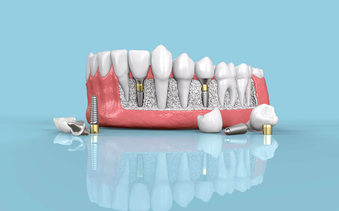 Dental Implants