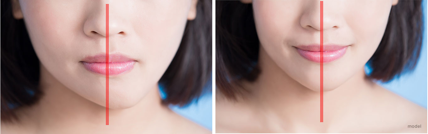 Chin Implant Before and After