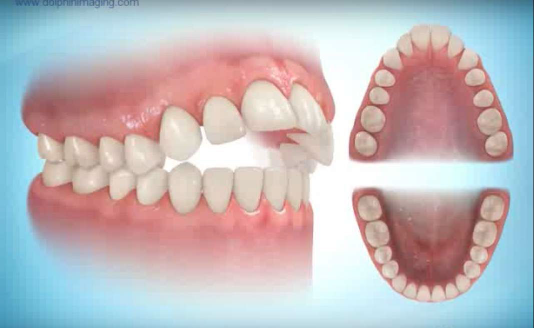 anterior open bite