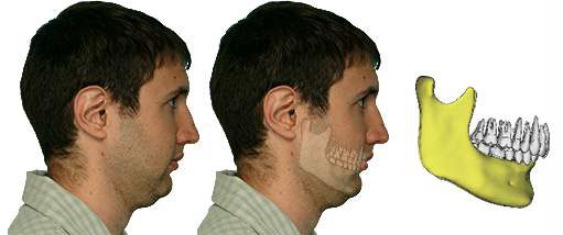 Face with Bimaxillary retrusion