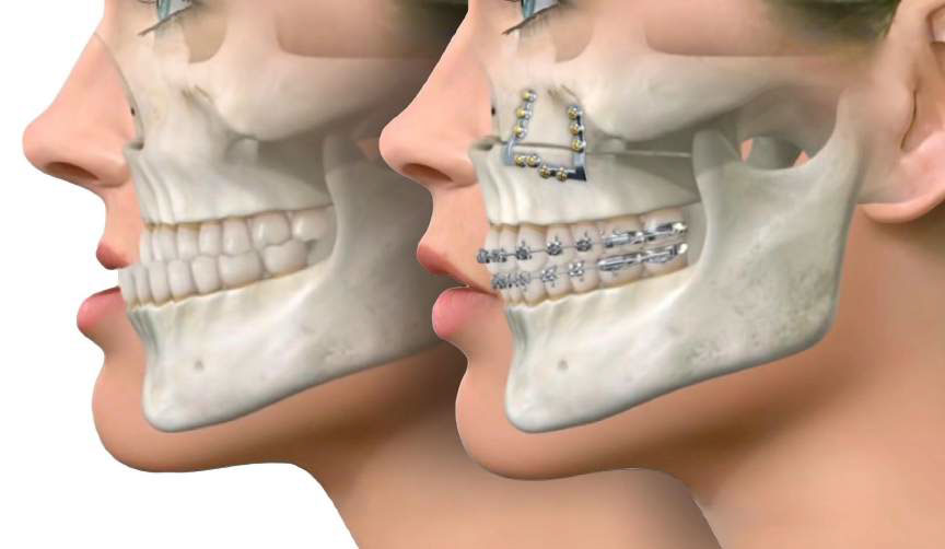 Le Fort I - Jaw Surgery