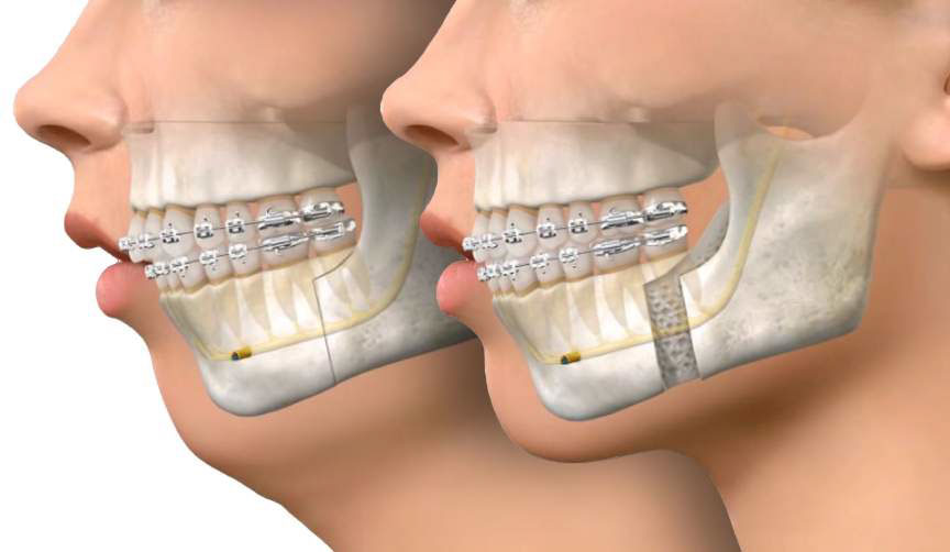 BSSO - Jaw Surgery