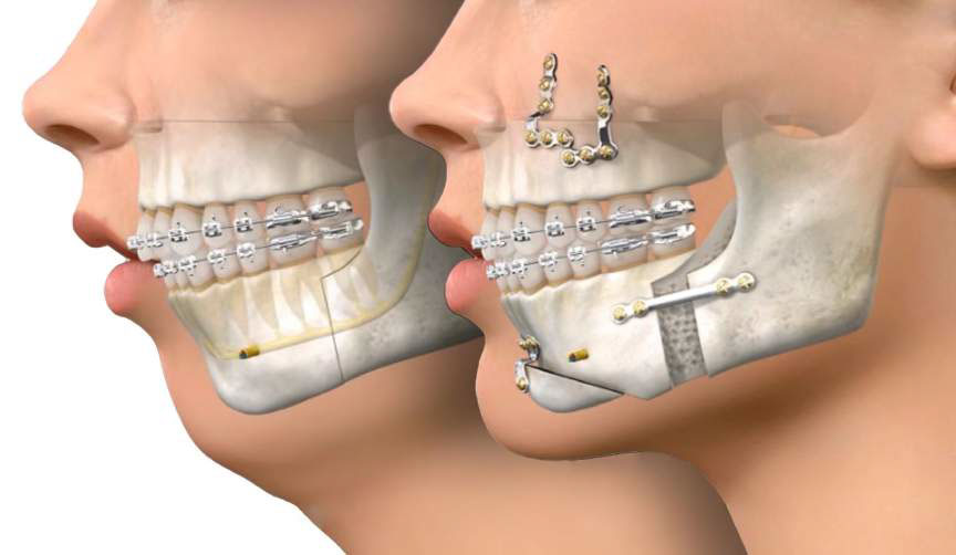 BiMax - Jaw Surgery