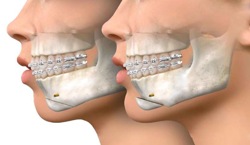 Genioplasty and GenioPaully - Jaw Surgery