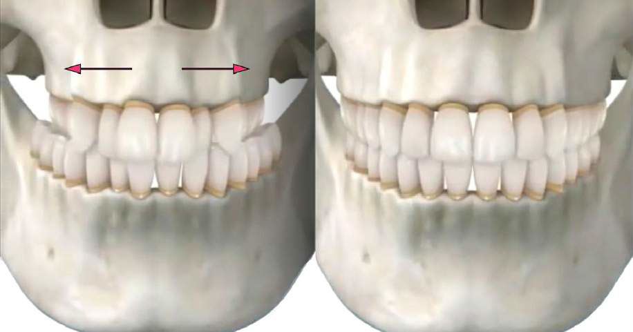 SARME - Jaw Surgery