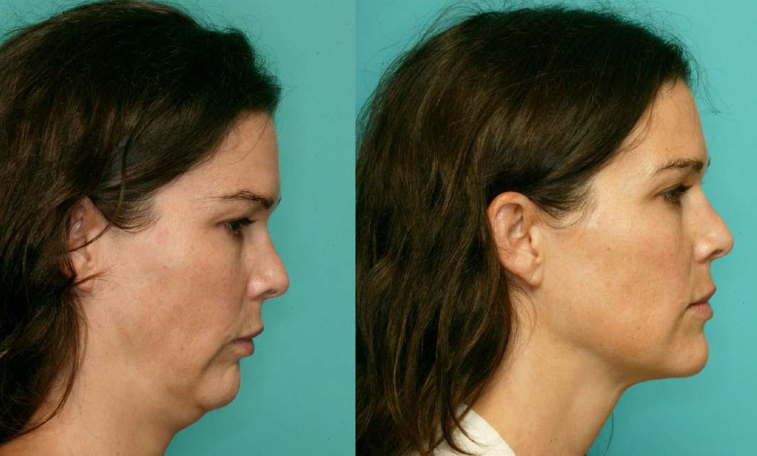 Orthognathic Jaw Surgery before and after