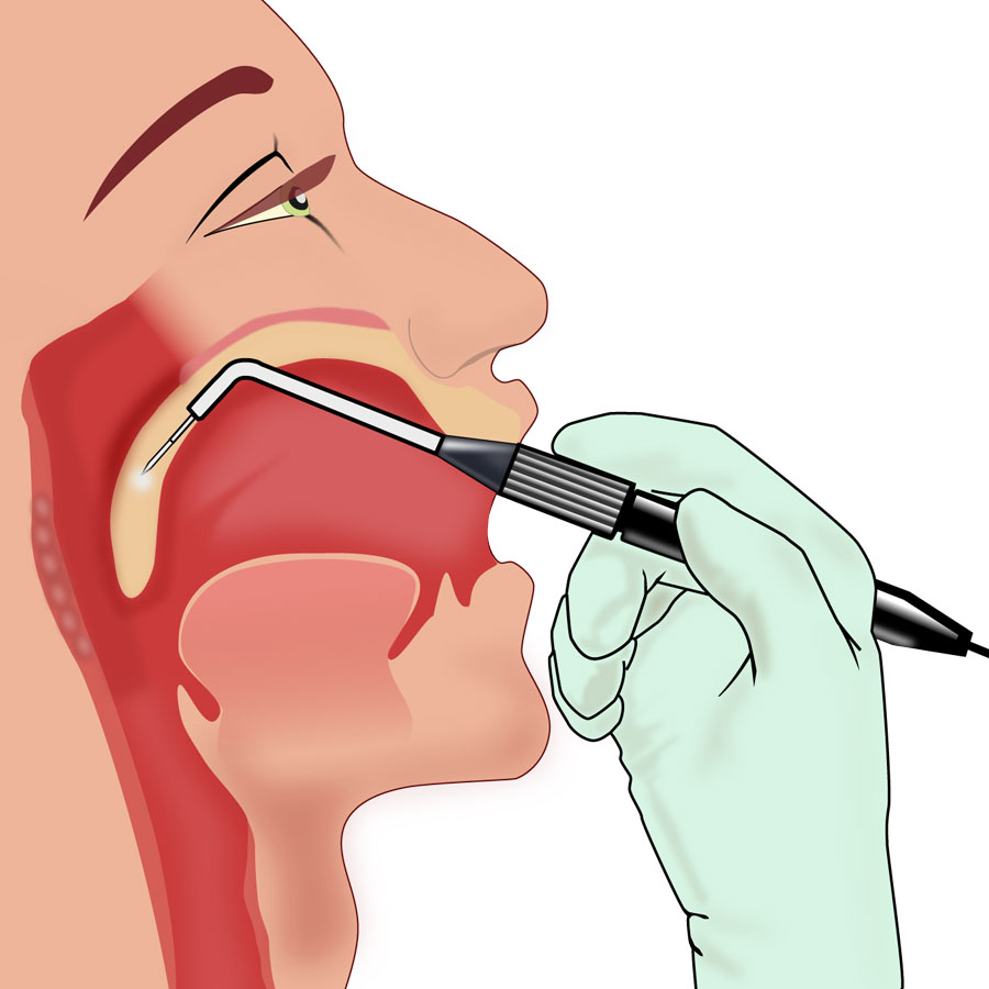 Illustration of surgery on the mouth and throat