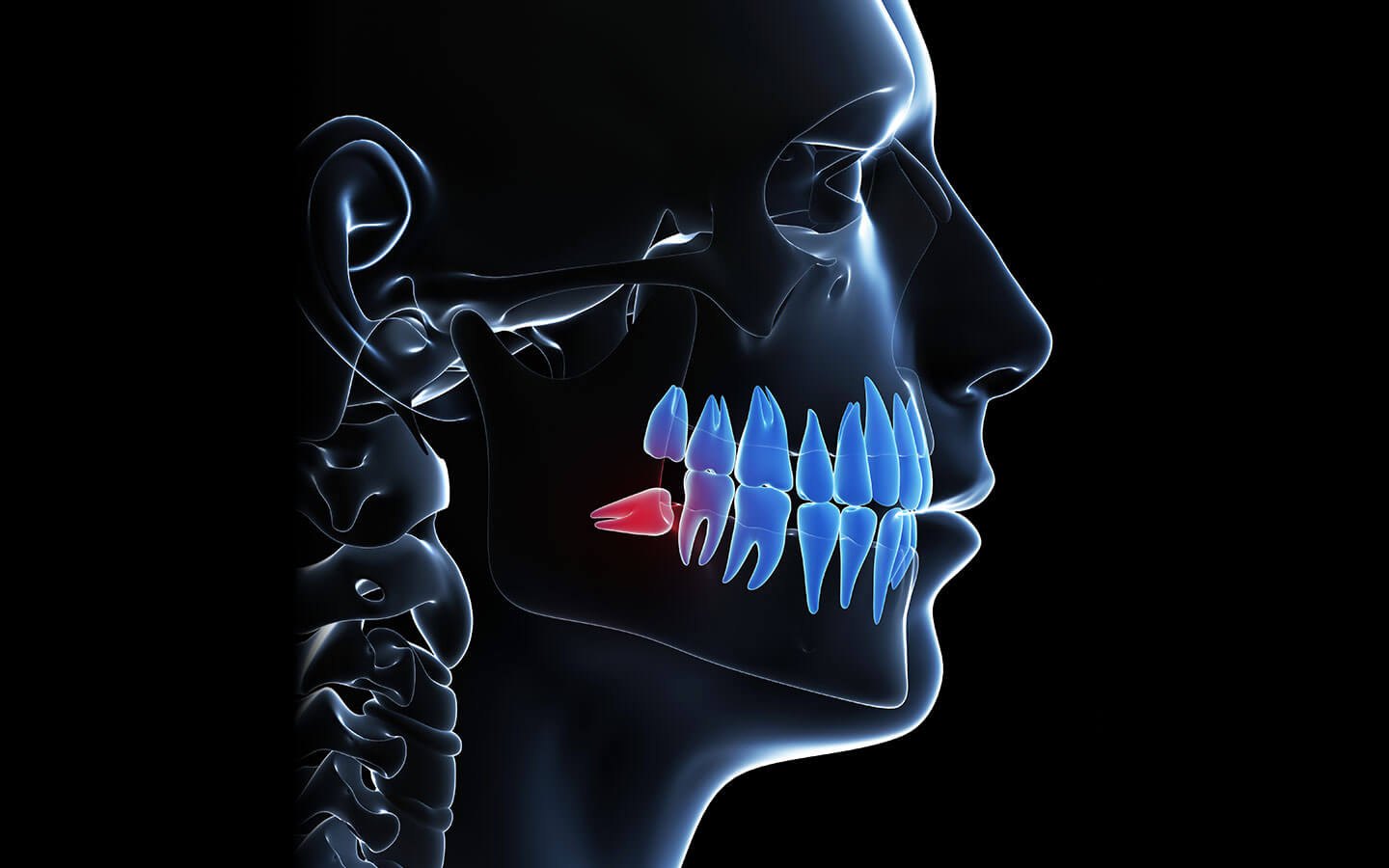 Wisdom Tooth Removal