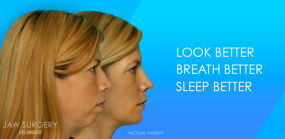 Jaw Surgery Los Angeles - Patient Before and After Jaw Surgery Los Angeles - Patient Before and After 1
