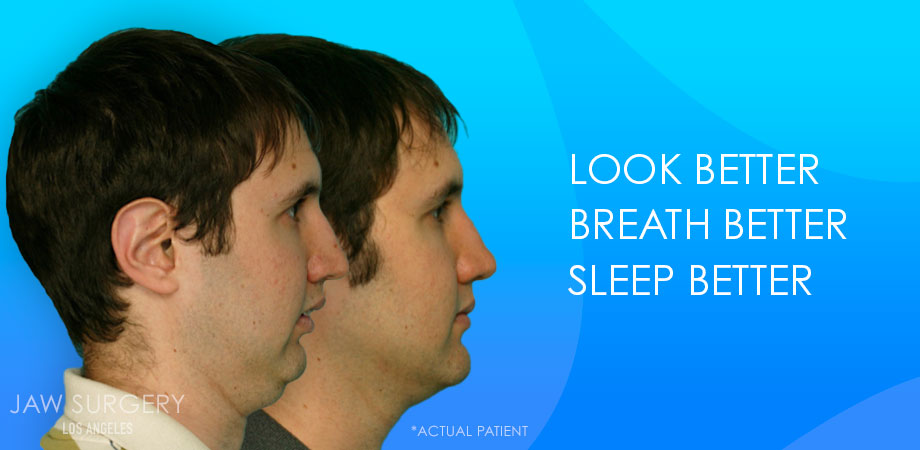 Jaw Surgery Los Angeles - Patient Before and After Jaw Surgery Los Angeles - Patient Before and After 2