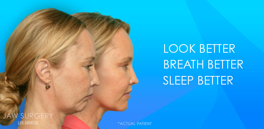 Jaw Surgery Los Angeles - Patient Before and After Jaw Surgery Los Angeles - Patient Before and After 3