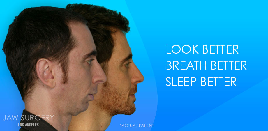 Jaw Surgery Los Angeles - Patient Before and After Jaw Surgery Los Angeles - Patient Before and After 4