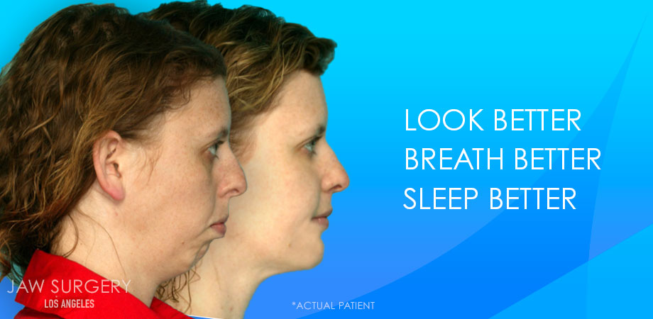 Jaw Surgery Los Angeles - Patient Before and After Jaw Surgery Los Angeles - Patient Before and After 6