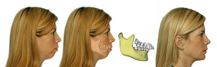 Correction of  Small Lower Jaw, before and after results