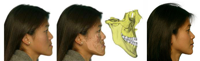 Correction of Small Upper Jaw before and after results