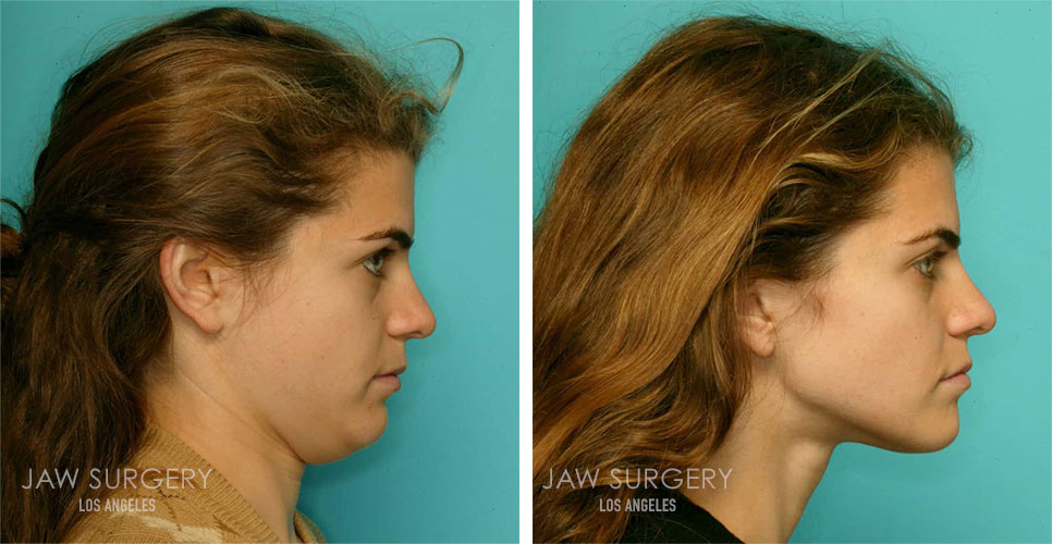 Before and After Patient Photo - Jaw Surgery 11.