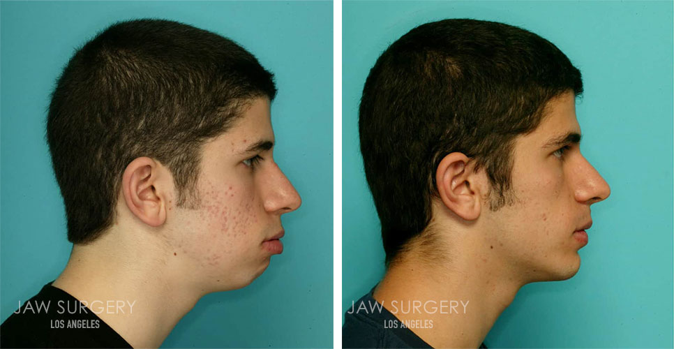 Before and After Patient Photo - Jaw Surgery 13
