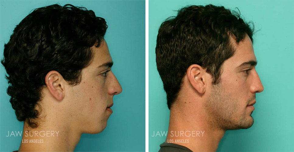Before and After Patient Photo - Jaw Surgery 15