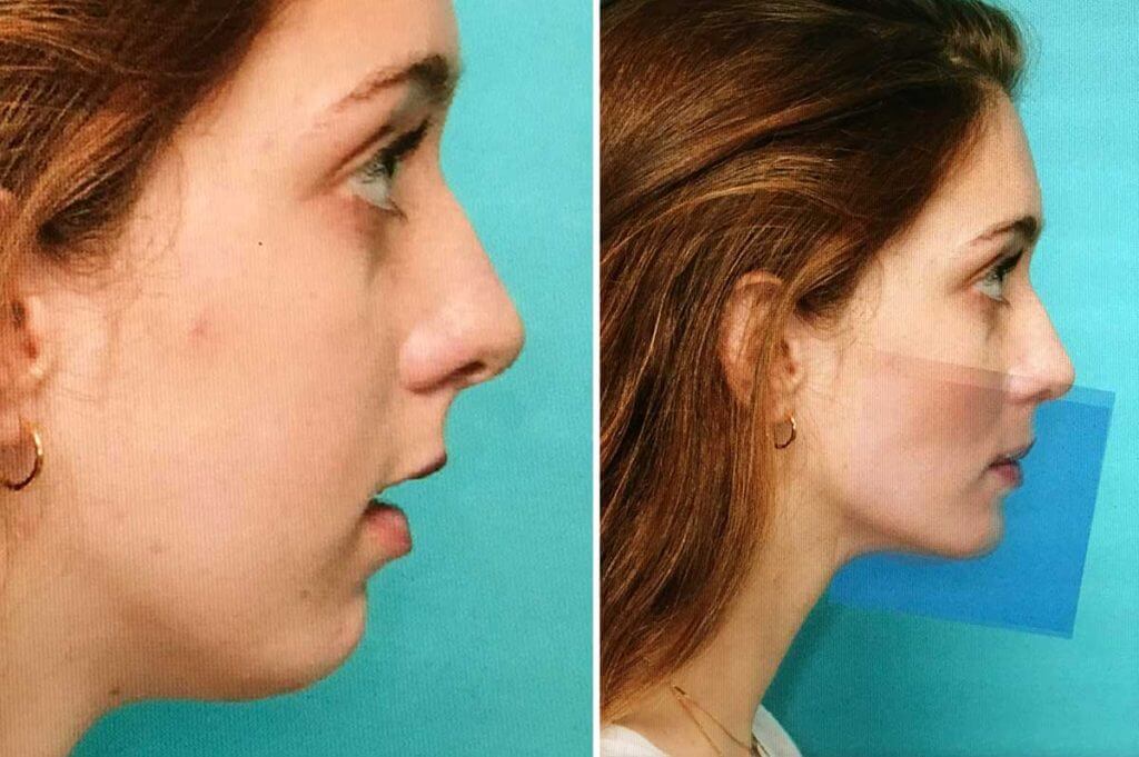 Jaw Surgery Before and After