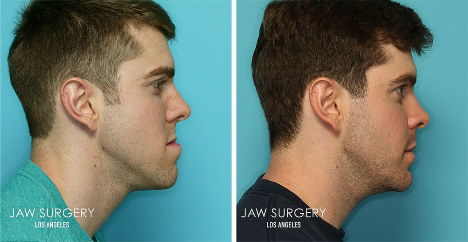 Before and After Patient Photo - Jaw Surgery 17