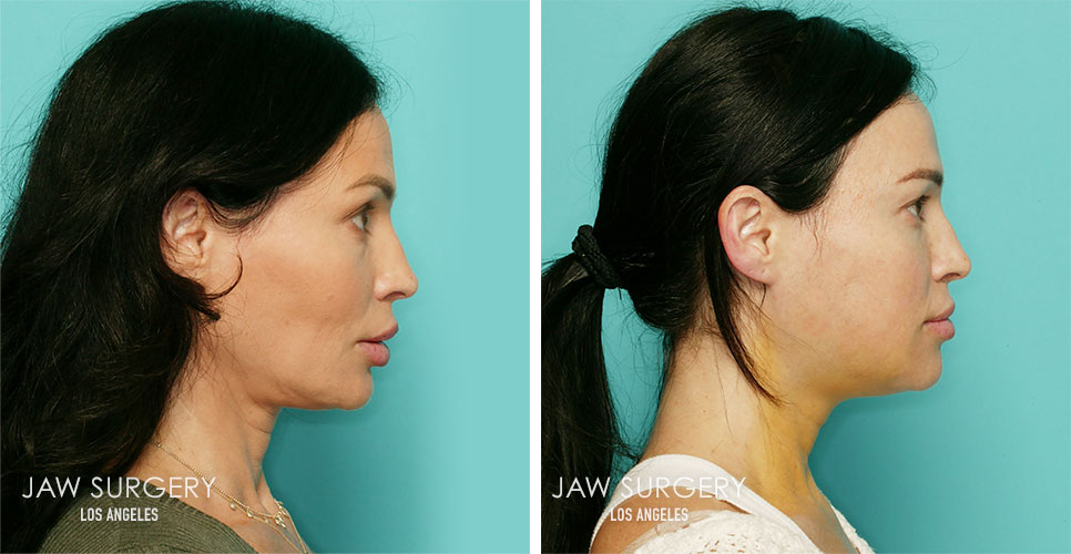 Jaw Surgery Before & After Photos - Law Plastic Surgery