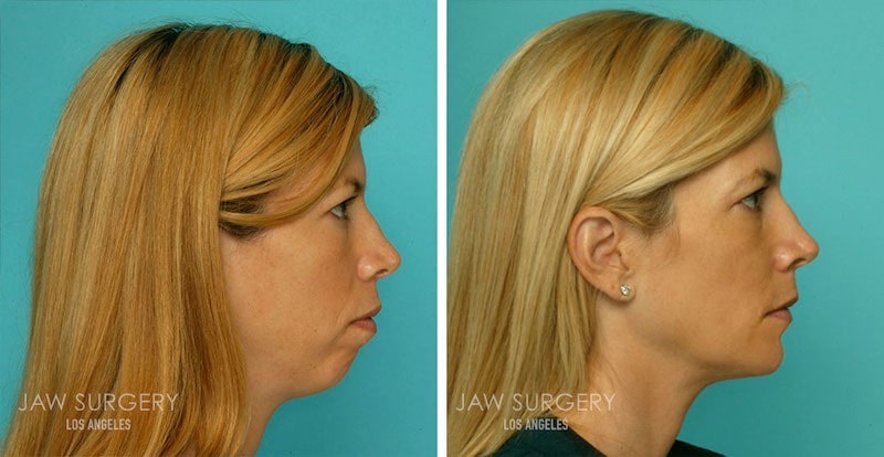 Before and after image showing the results of a double jaw surgery performed in Los Angeles, CA.