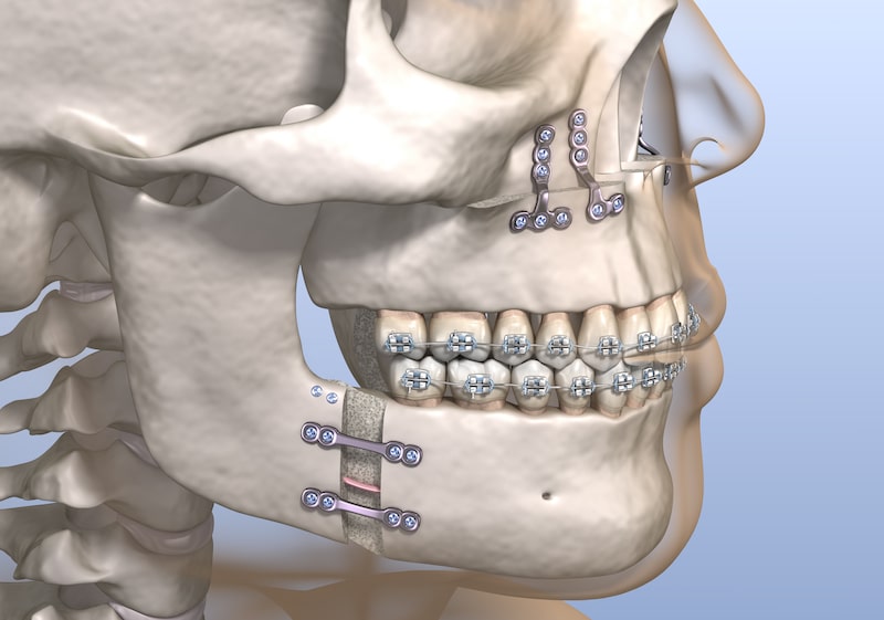 Vector illustration of jaw surgery