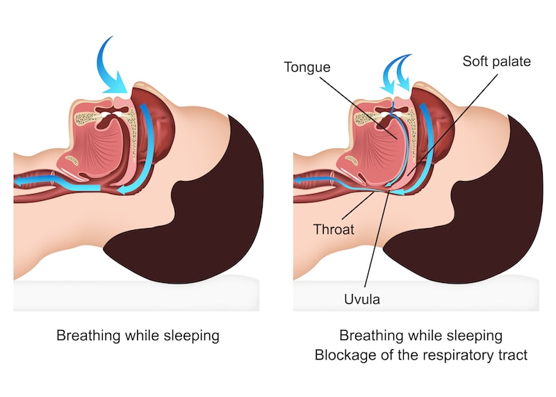 Illustration of sleep apnea