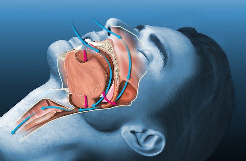 Vector illustration of obstructive sleep apnea