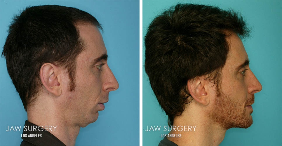 Before and After Patient Photo - Jaw Surgery