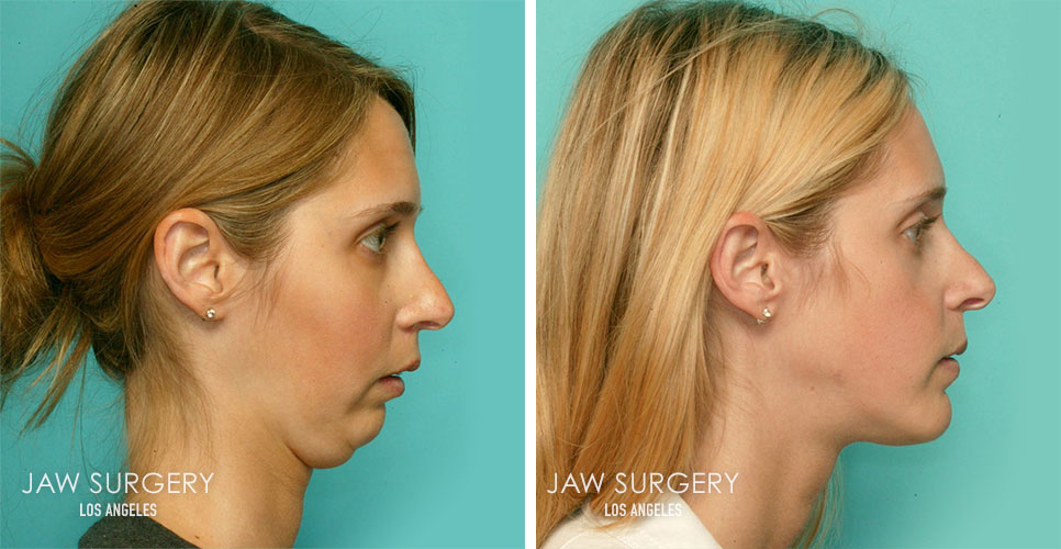 Before and After Patient Photo - Jaw Surgery 2