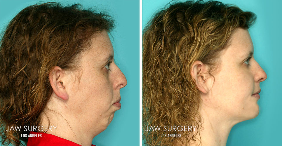 Before and After Patient Photo - Jaw Surgery 3