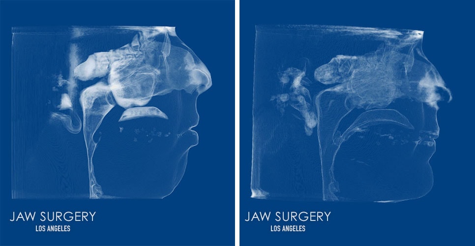 Before and After Patient Photo xRay - Jaw Surgery