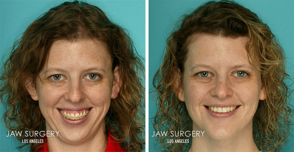 Before and After Patient Photo - Jaw Surgery 3 Frontal View