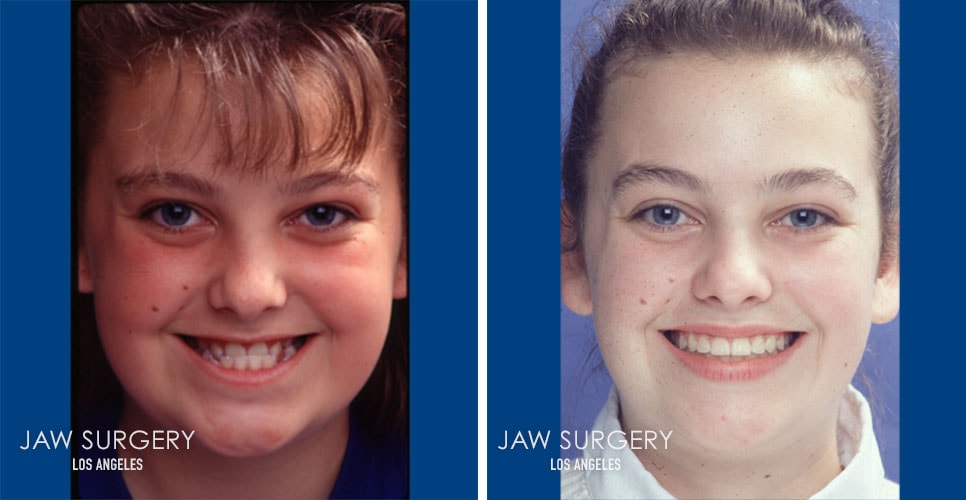 Before and After Patient Photo - Jaw Surgery 4