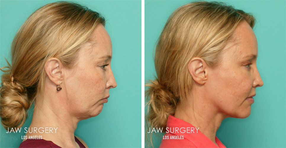 Before and After Patient Photo - Jaw Surgery 5