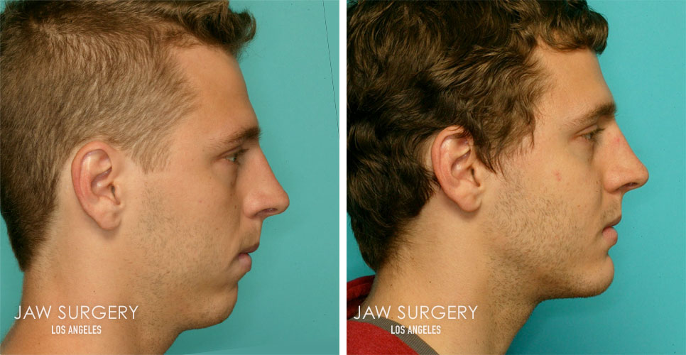 Before and After Patient Photo - Jaw Surgery 6