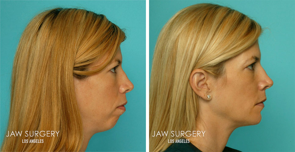 Before and After Patient Photo - Jaw Surgery 7