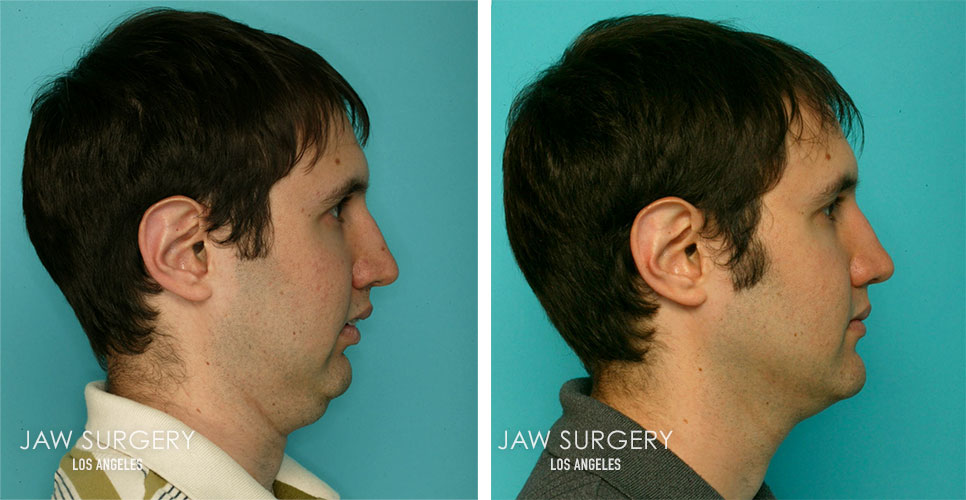 Before and After Patient Photo - Jaw Surgery 8