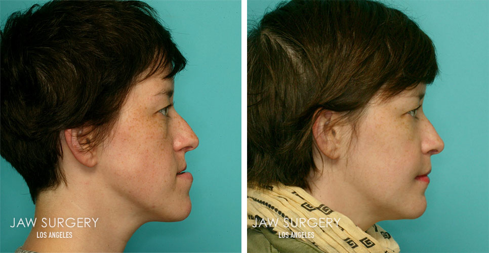 Before and After Patient Photo - Jaw Surgery 9