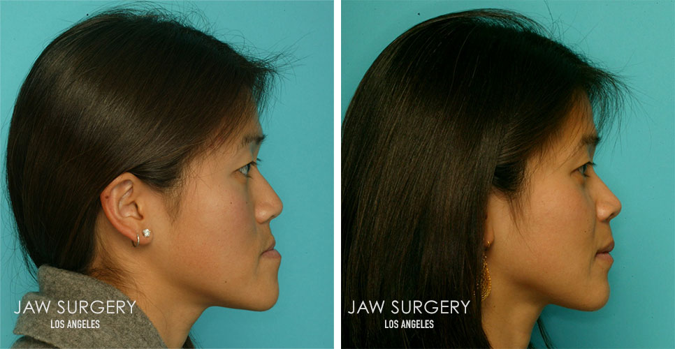 Before and After Patient Photo - Jaw Surgery 10