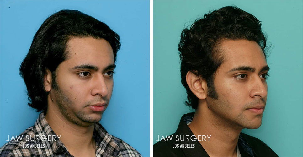 Before and After Patient Photo - Jaw Surgery 12